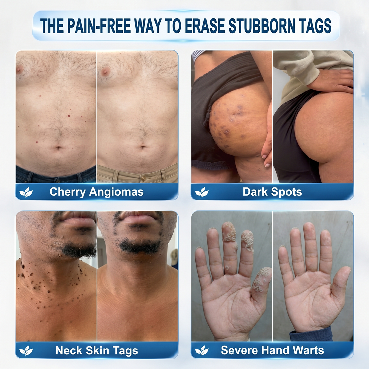 ✨ Official CAN Store | Natravor® 7-Day Skin Tag & Blemish Roll-On – Painless & Scar-Free