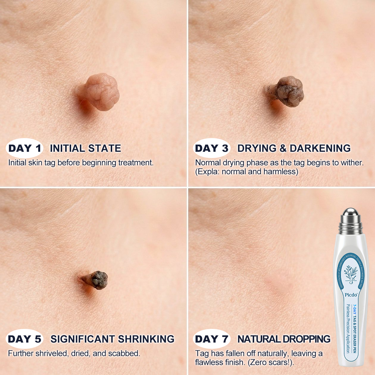 ✨ Official CAN Store | Natravor® 7-Day Skin Tag & Blemish Roll-On – Painless & Scar-Free