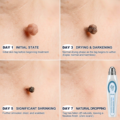 ✨ Official CAN Store | Natravor® 7-Day Skin Tag & Blemish Roll-On – Painless & Scar-Free